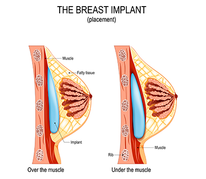 Breast Augmentation Surgery Procedure Benefits Recovery